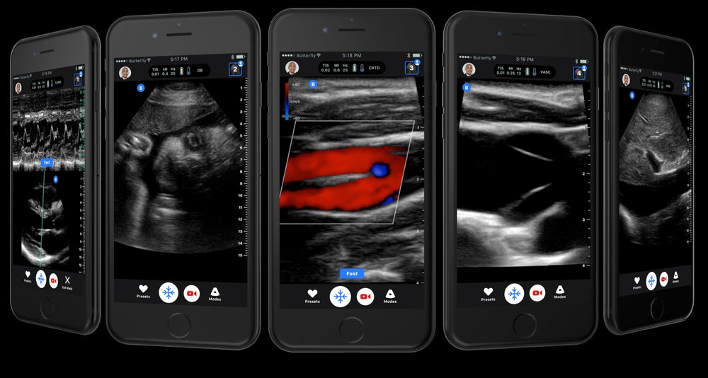 portable-ultrasound-butterfly-iq-2.jpg